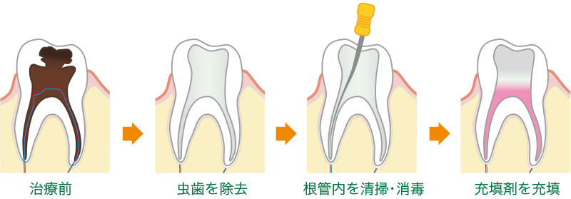 歯の神経の治療の流れ